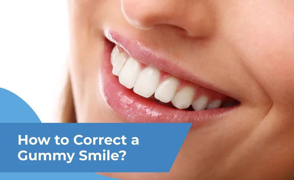 How to Correct a Gummy Smile?