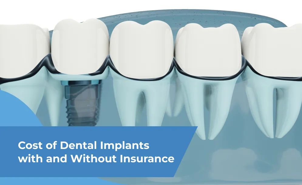 Cost of Dental Implants with and Without Insurance