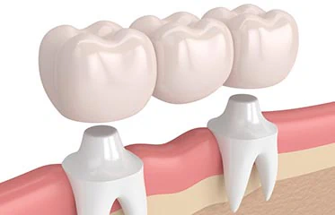 Dental Bridges Simi Valley