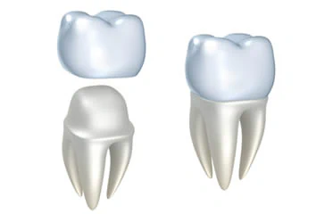 Dental Crowns Simi Valley