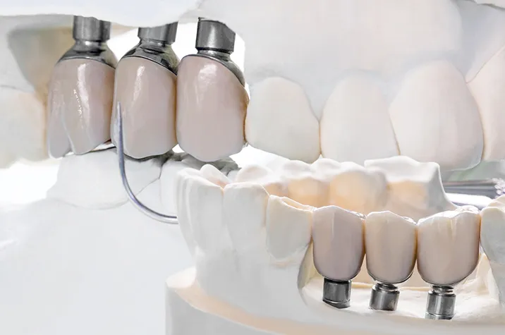 How to Look After your Implants and Dentures?