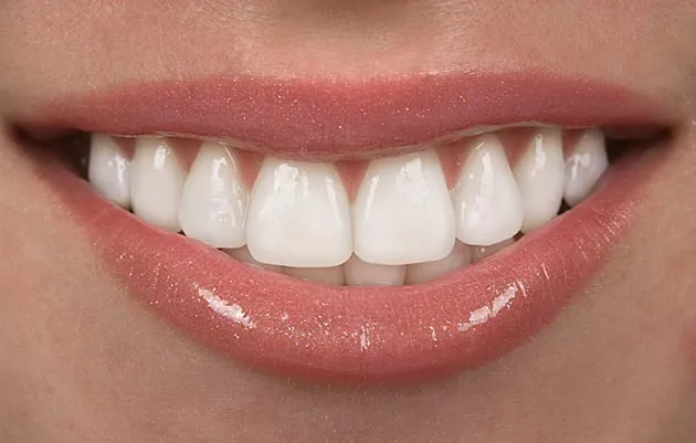 How Long Do Porcelain Veneers Last?