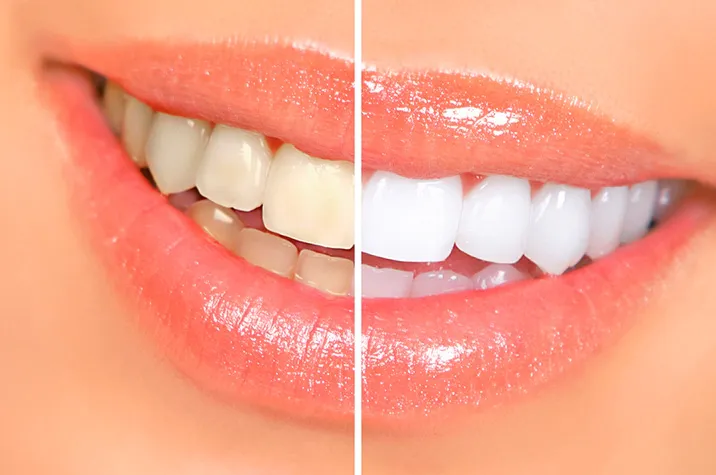 Dentist in Pasadena Encourages Patients to Choose the Right Teeth Whitening Solution