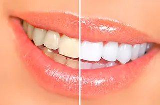What Causes Tooth Stains and How to Get Rid of Them?