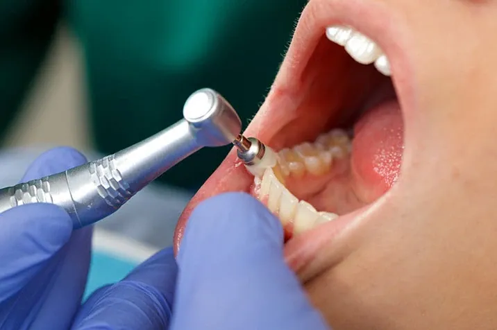 What Is a Dental Plaque and How to Remove It?