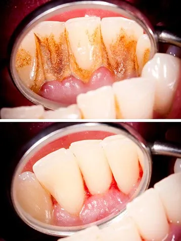 How to Know When Gum Recession Requires an Evaluation from a Dental Professional?