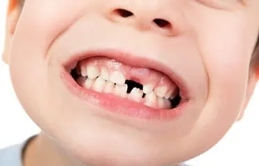 What to Do When a Tooth Falls Out?