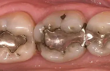 Is There a Difference Between Metal or Silver Fillings & Tooth-colored Fillings?