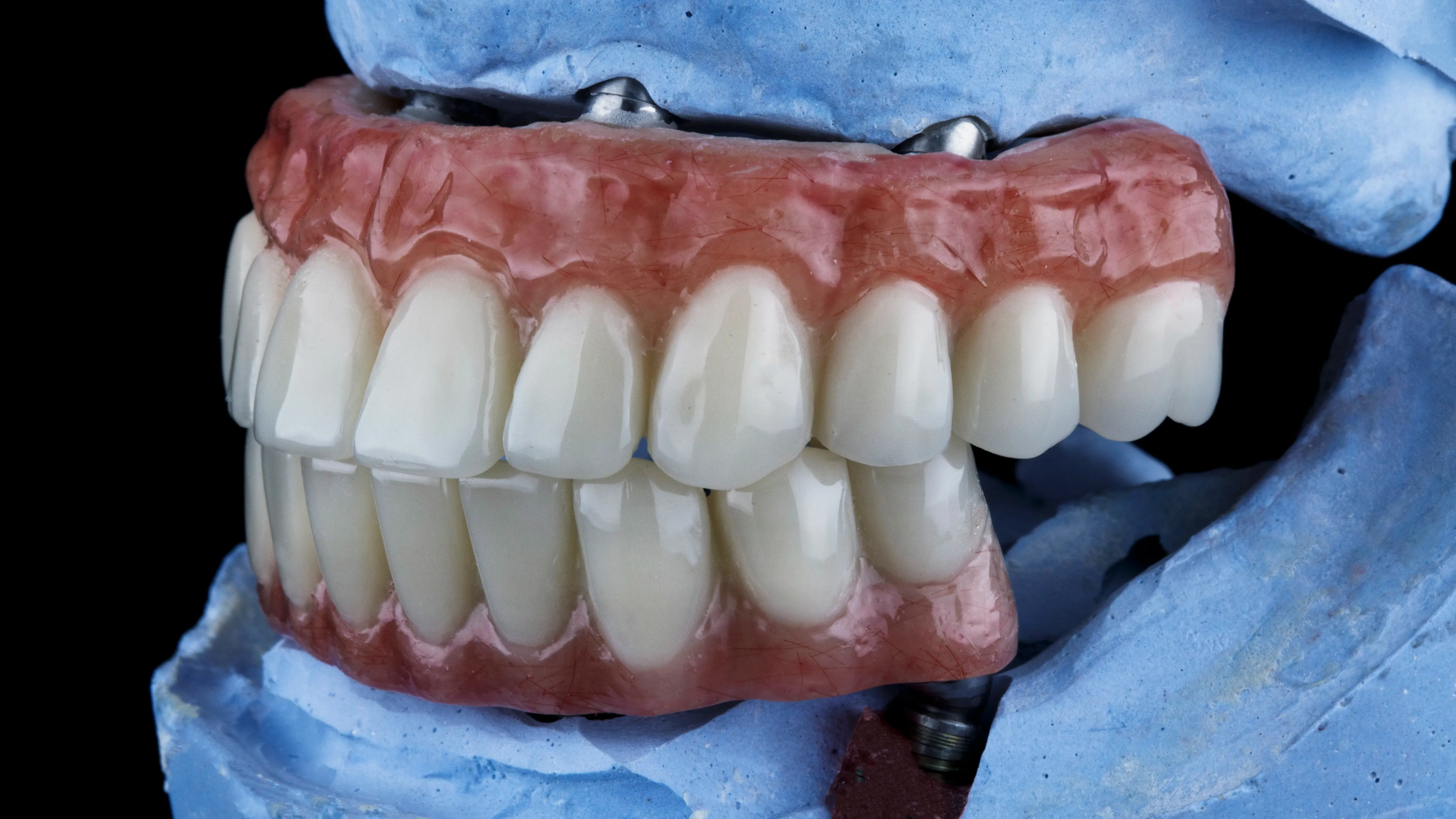 What is an Implant Overdenture, Dental Implants and how do I know if I'm a candidate for it