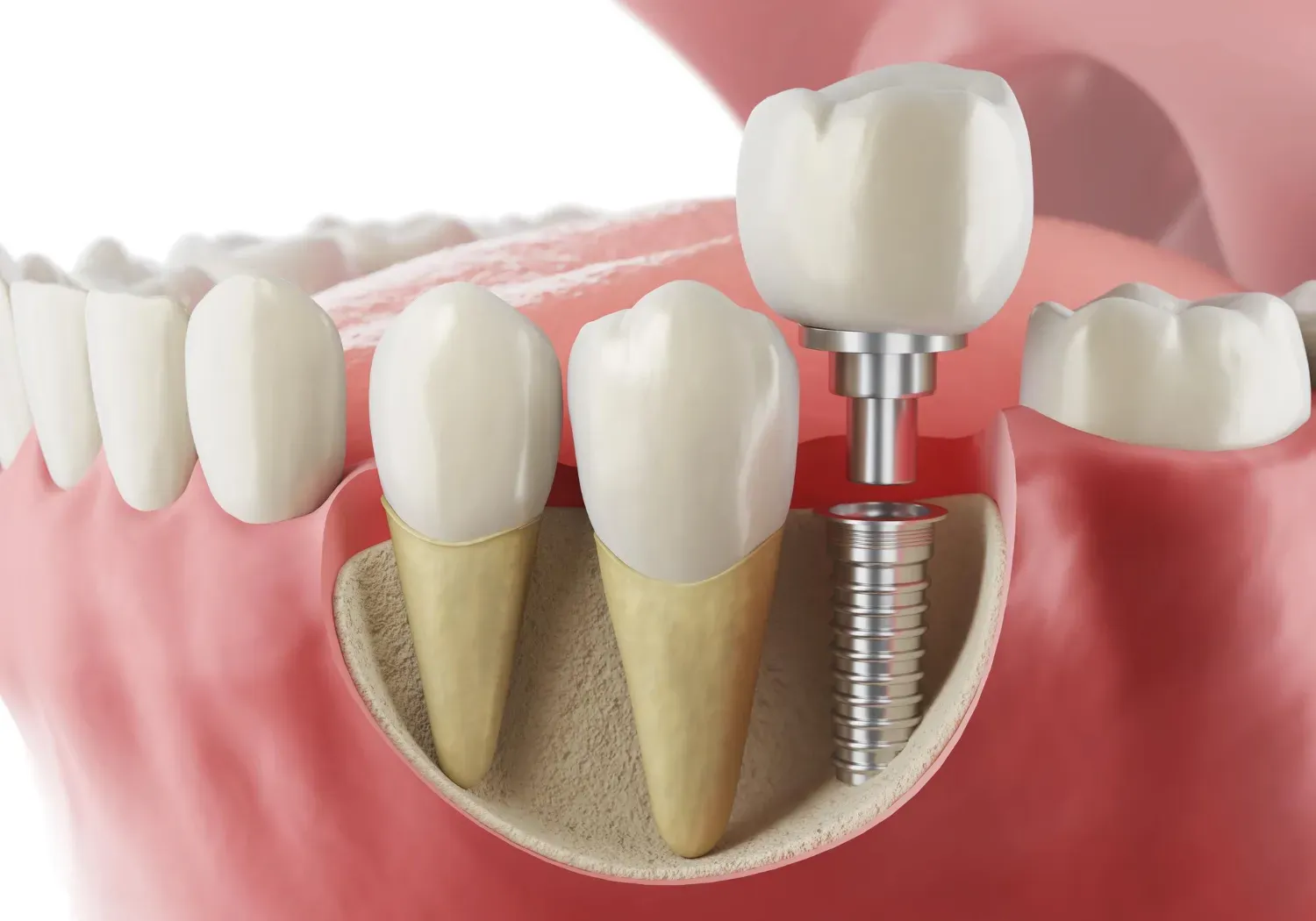 Six Reasons Why Dental Implants are so Popular?