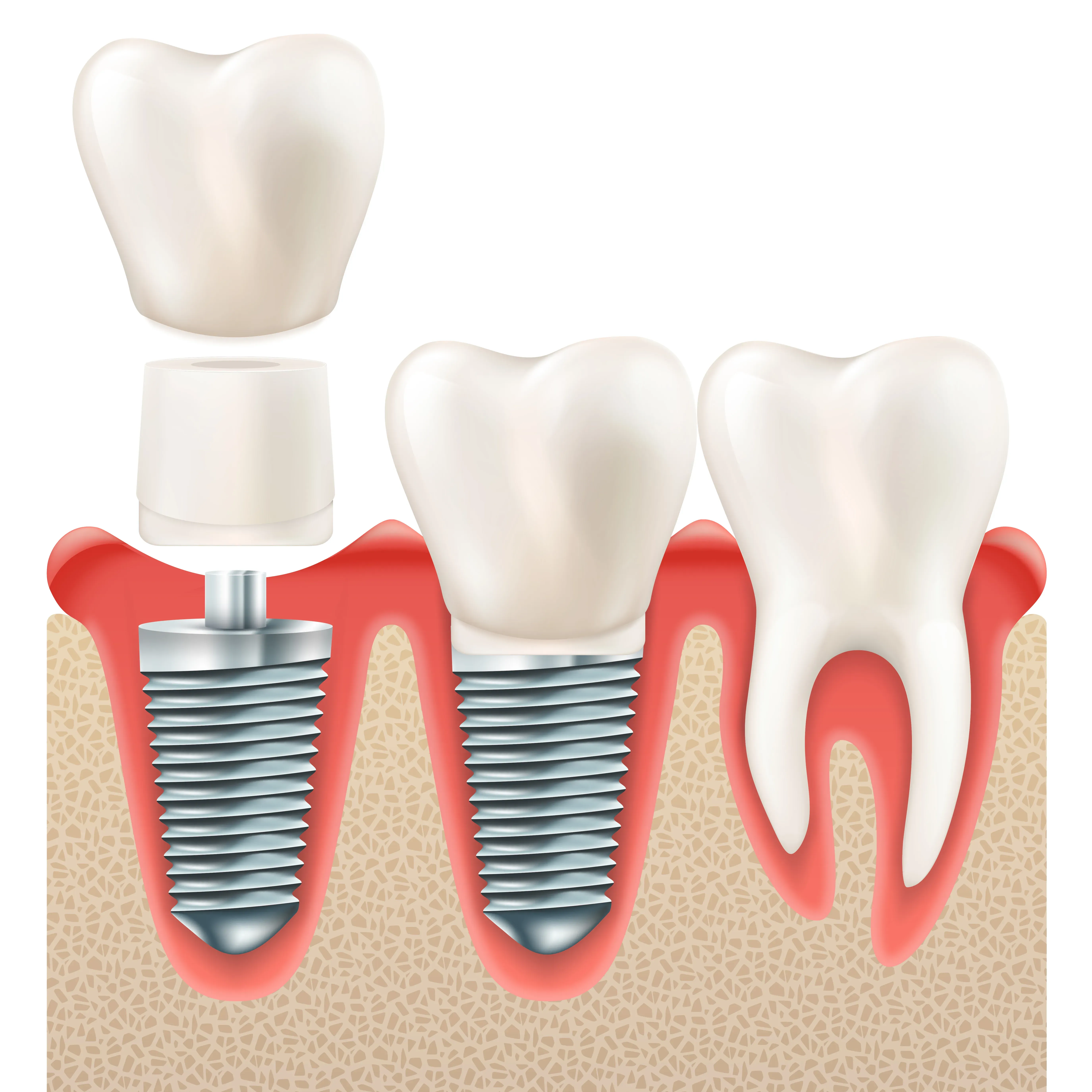 Does Dental Insurance Cover Implants?