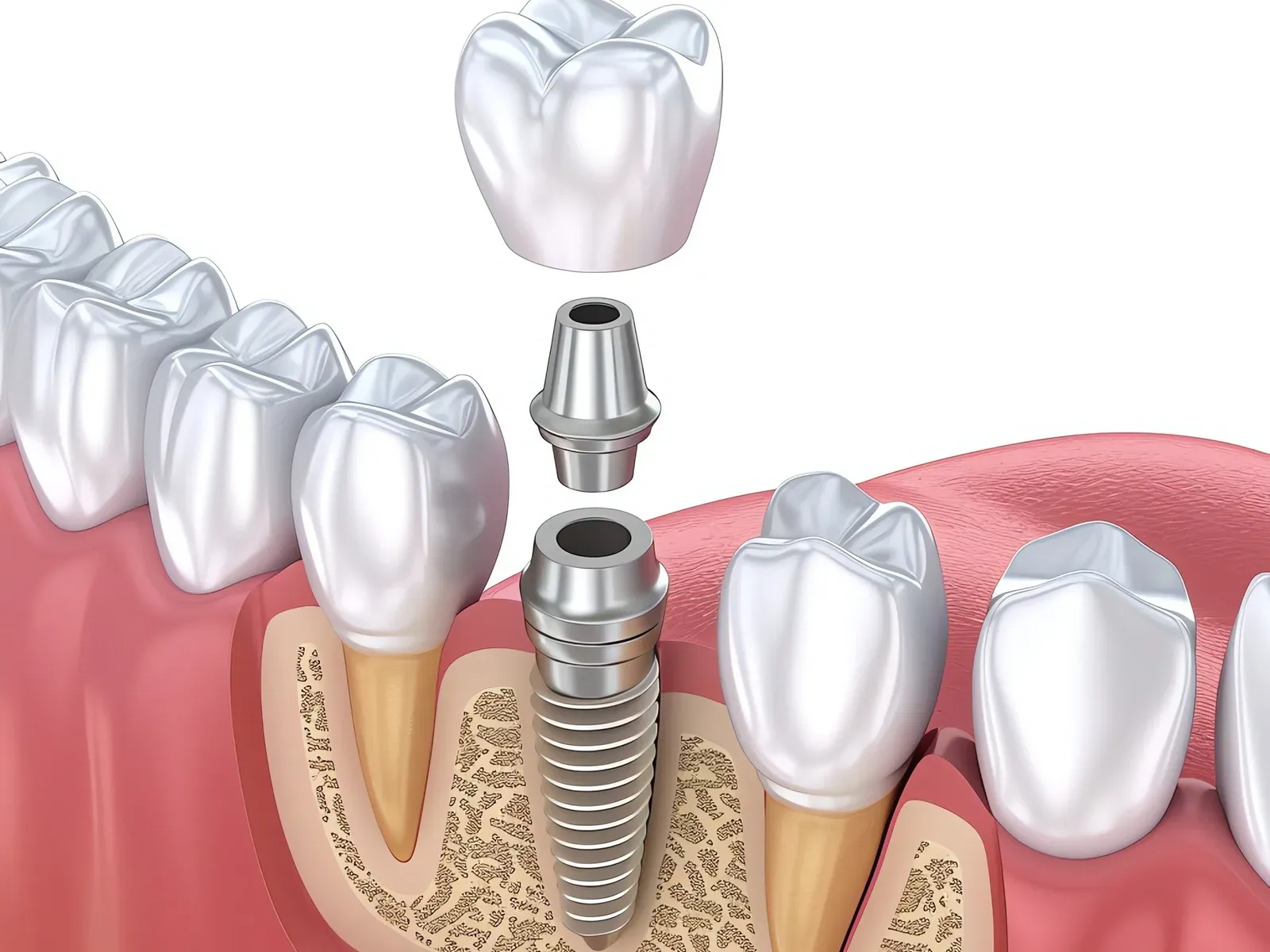 The ABC of Dental Implants