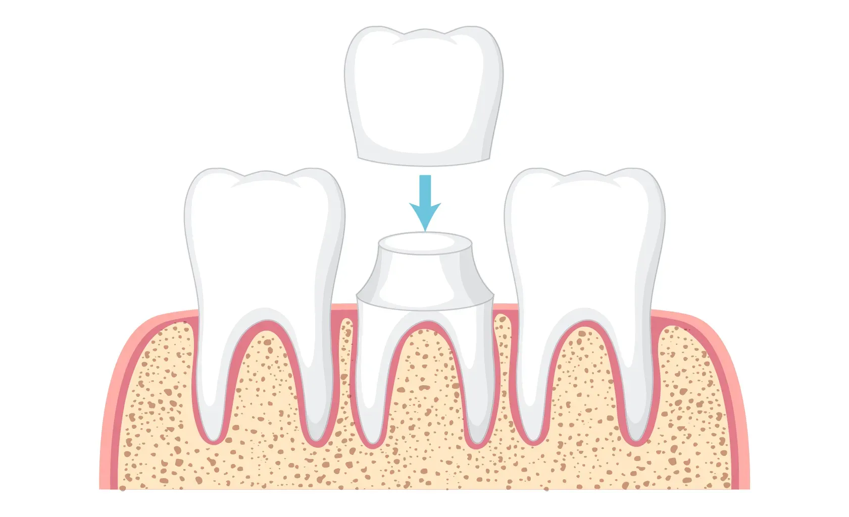 What to Expect When Getting a Crown?