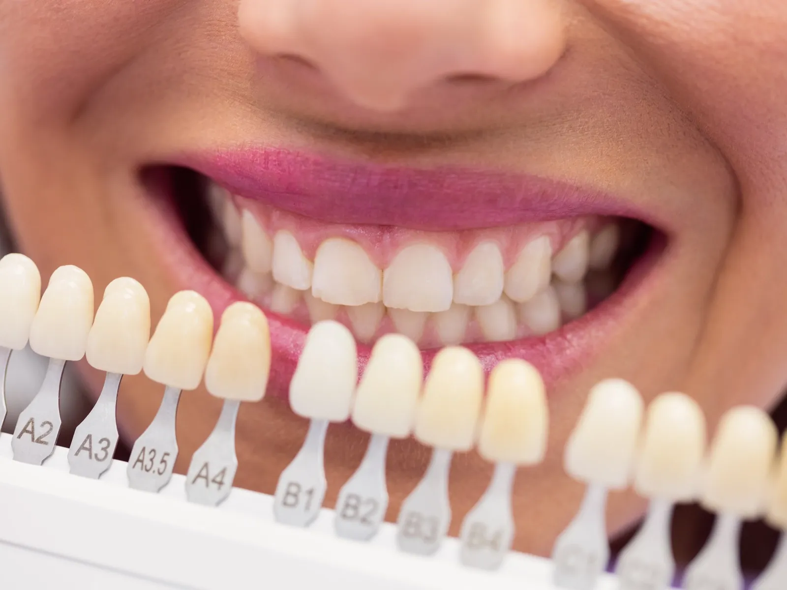 Am I a Candidate for Veneers?