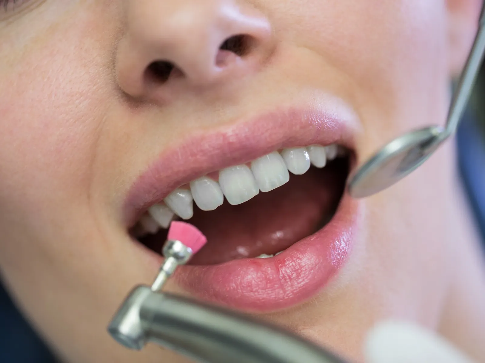 Using Composite Resin Fillings