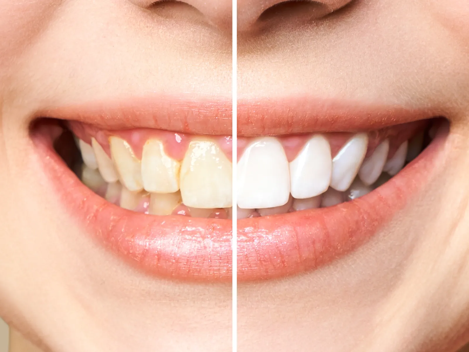 Can I Have Teeth Whitening If I Have Crowns, Veneers, or Implants?