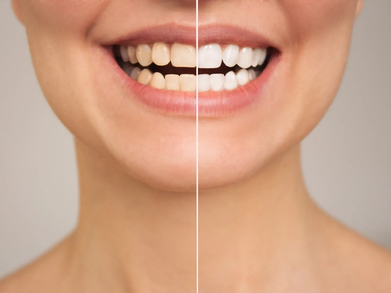 Brighten Your Smile with Teeth Whitening Offered by Dentist in Simi Valley