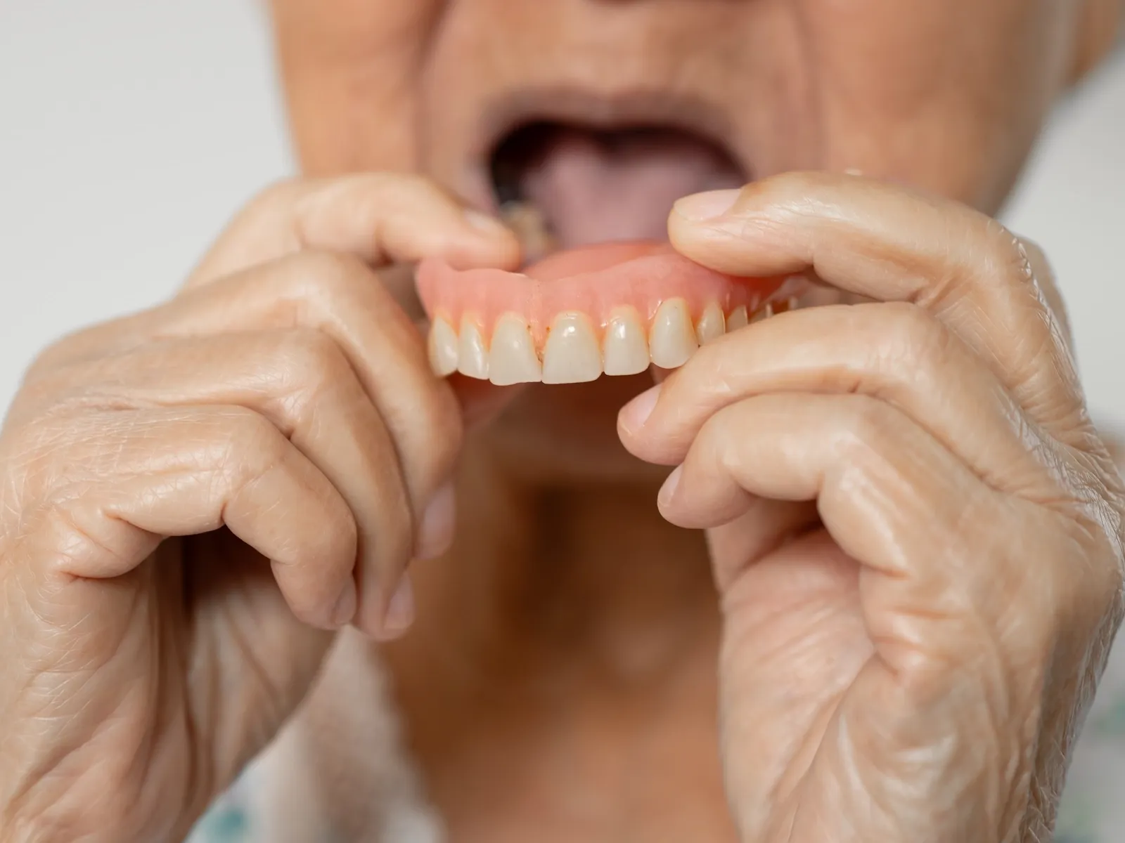 Implants with Dentures for an Amazing Smile Restoration
