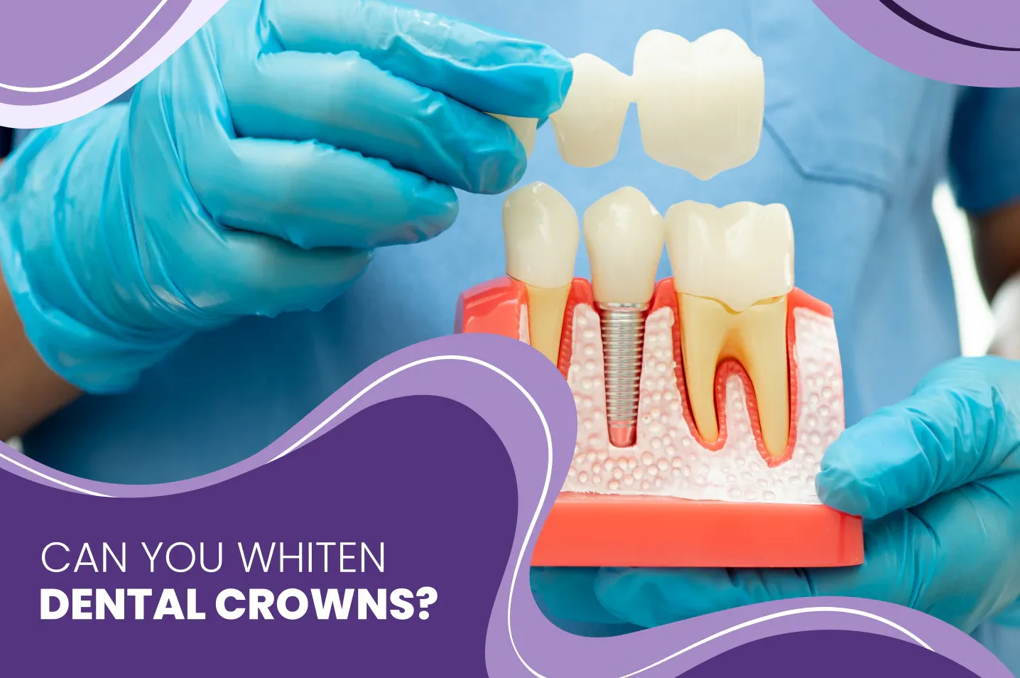 Can You Whiten Dental Crowns?