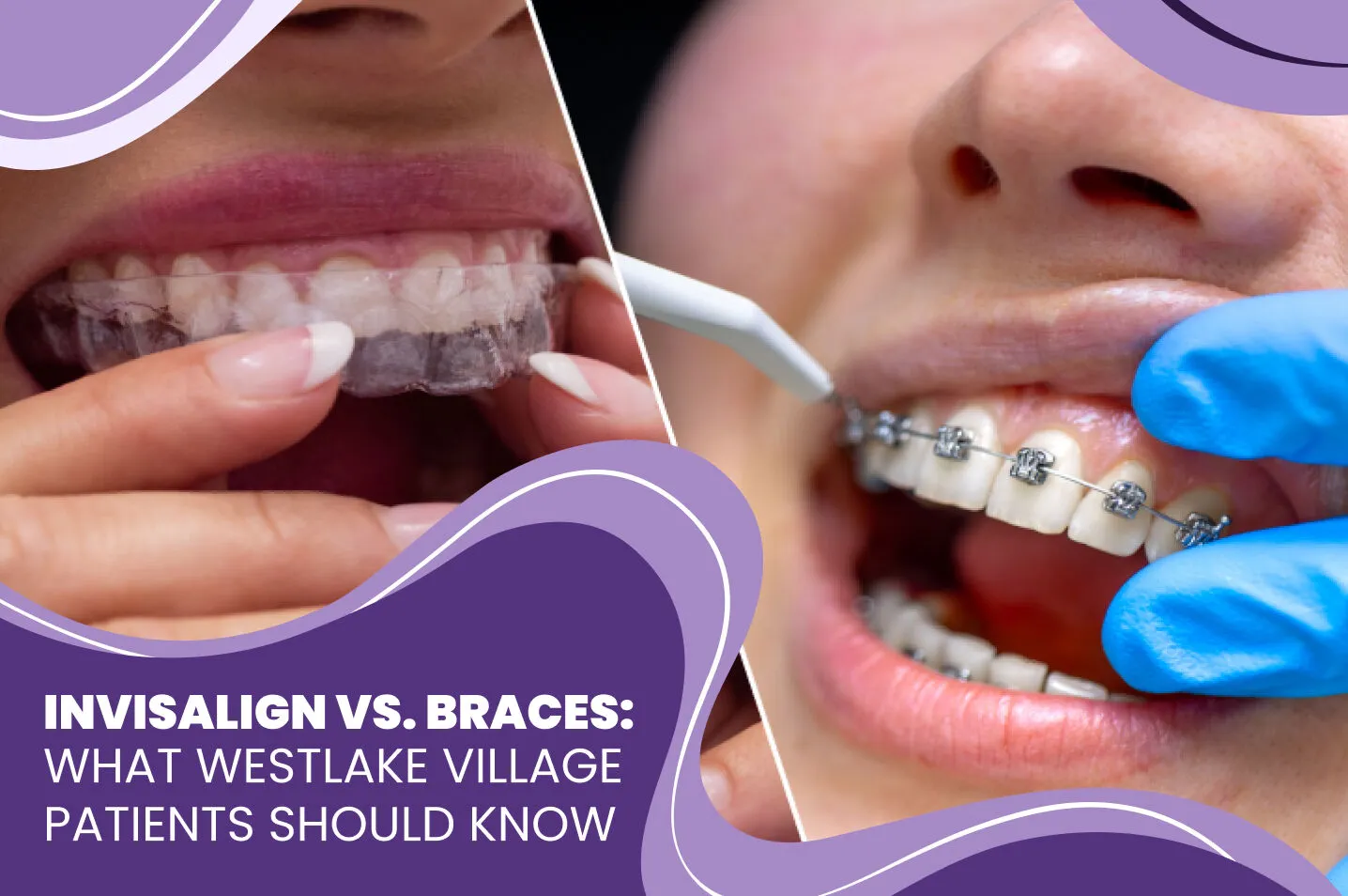 Invisalign vs. Braces: What Westlake Village Patients Should Know