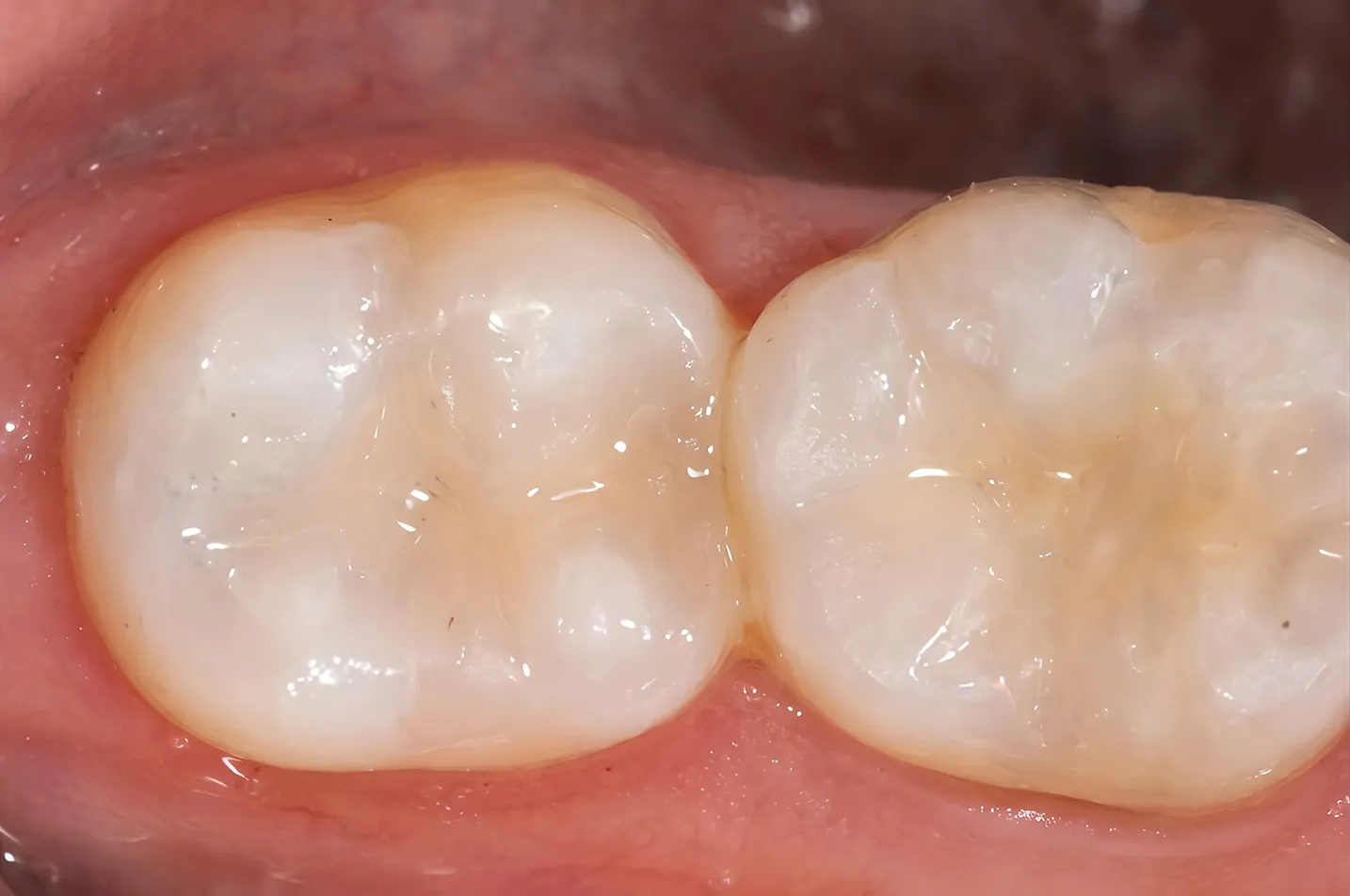 White Fillings Simi Valley