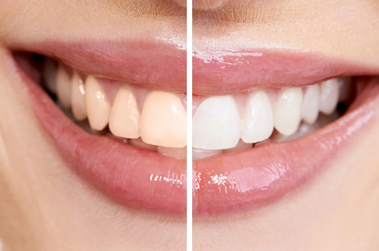 Teeth Whitening Treatment in Pasadena Simi Valley