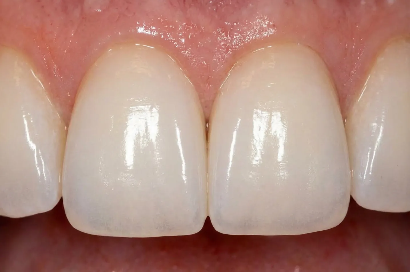 Composite Bonding Simi Valley