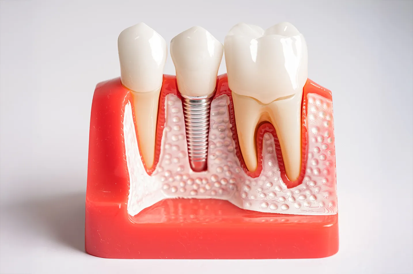 Before, During & After Dental Implants Simi Valley