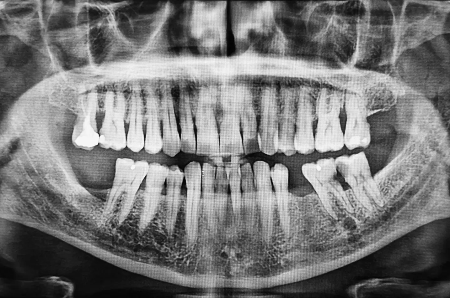 Digital X-Rays Simi Valley