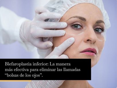 Blefaroplastia inferior: La manera más efectiva para eliminar las llamadas “bolsas de los ojos”