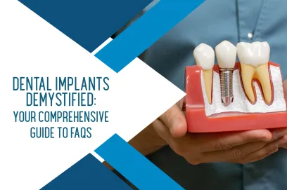 Dental Implants Demystified: Your Comprehensive Guide to FAQs
