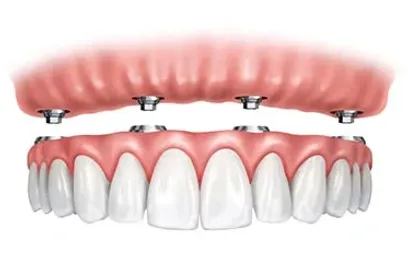 What to Do After Dental Implant Surgery?