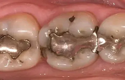 Is There a Difference Between Metal or Silver Fillings & Tooth-colored Fillings?
