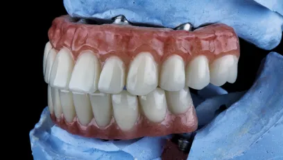 What is an Implant Overdenture, Dental Implants and how do I know if I'm a candidate for it