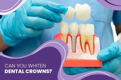 Can You Whiten Dental Crowns?